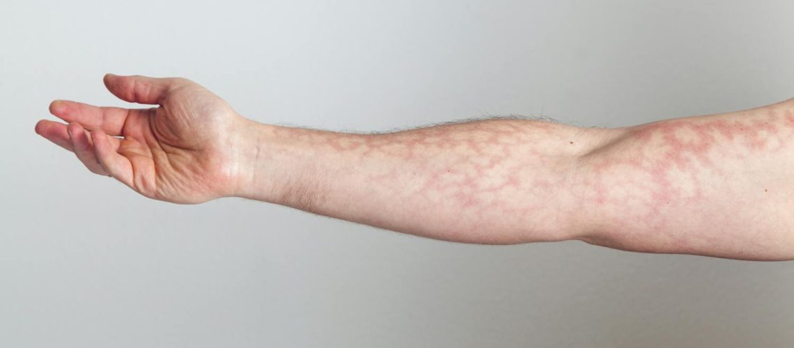 Peau marbrée : faut-il s'inquiéter ?